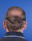 After Hair Transplant&nbsp;2 Sessions (Areas)